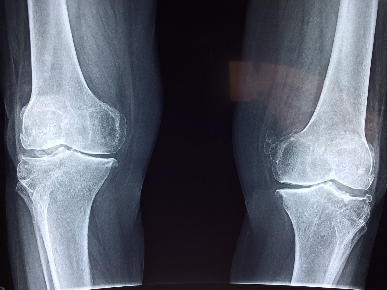 x-ray of two knees.