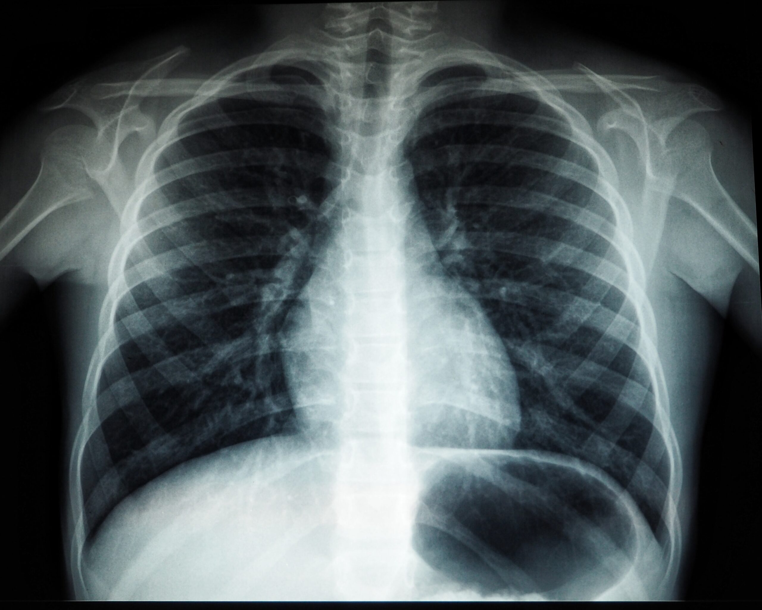 chest x-ray.